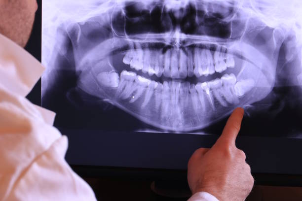 Best Emergency Dental Extractions in Dana Point, CA